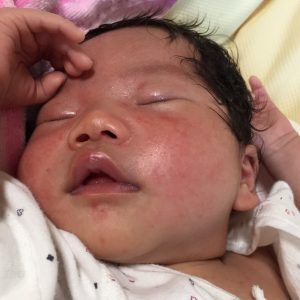 乳児湿疹